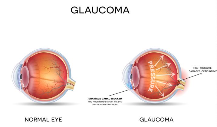 diagram of healthy eye vs eye with glaucoma