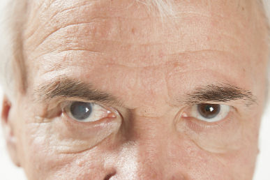Senior man with cataracts